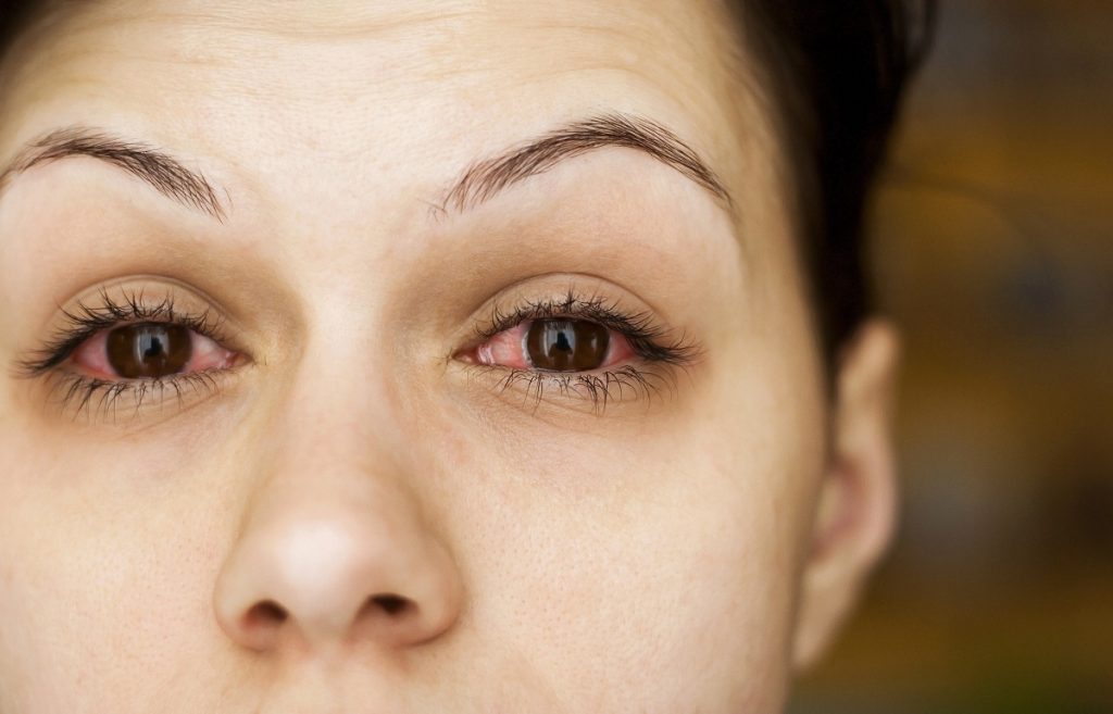 حساسیت چشم به مواد آرایشی