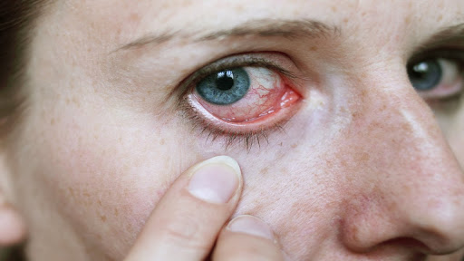 درمان آلرژی چشم