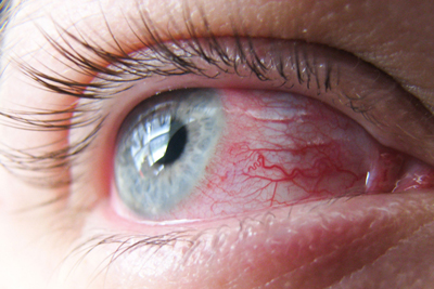 چرا لنز باعث عفونت چشمی می‌شود؟
